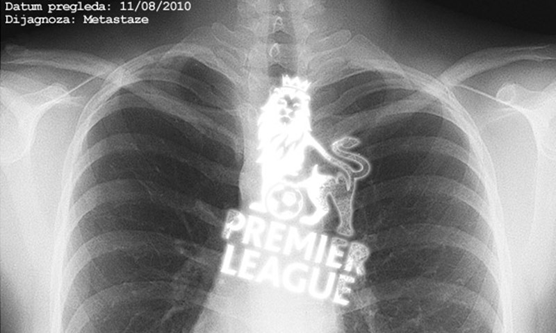 Metastaze