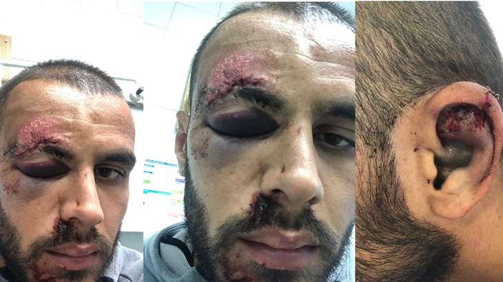 Slaven Belupo objavio fotografije Ejupijeve "lakše" ozljede: "Muzo, vrati nam se što prije"